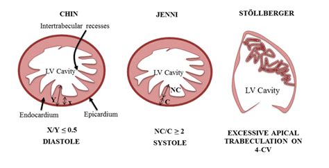 lv non compaction echo criteria|jenni criteria lvnc.